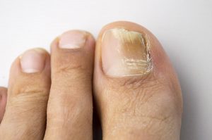 https://www.mayoclinic.org/diseases-conditions/nail-fungus/diagnosis-treatment/drc-20353300