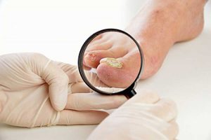 https://www.webmd.com/skin-problems-and-treatments/ss/slideshow-toenail-fungus 